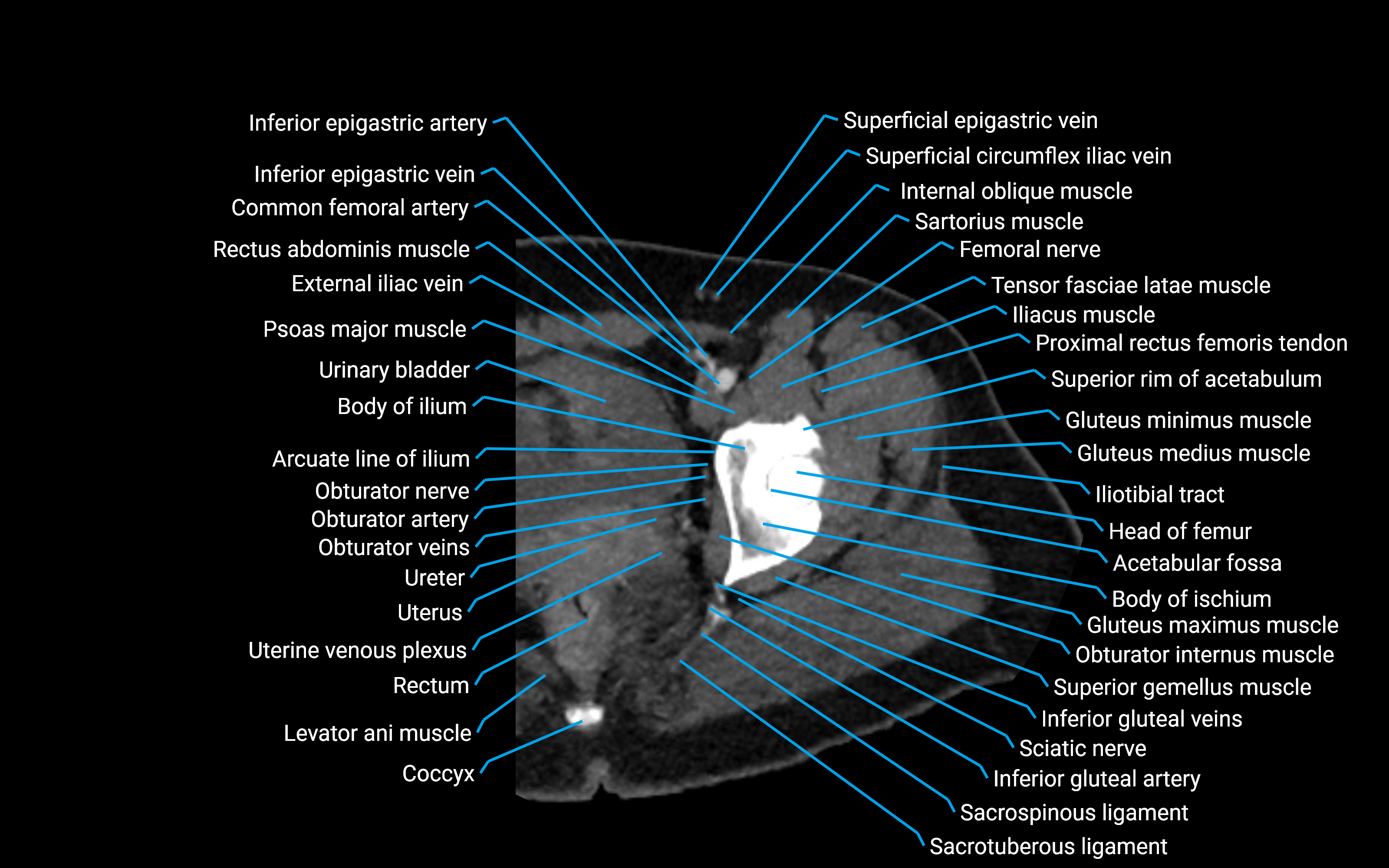 CT Hip axial cross sectional anatomy labelled image 4 (2).png
